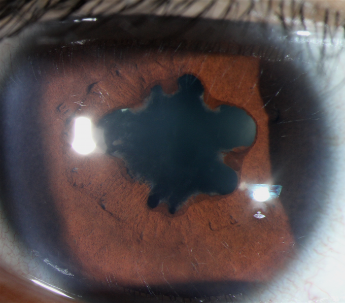 Irregular pupil from posterior synechiae