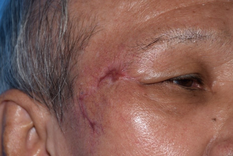 Surgical removal of the basal cell carcinoma