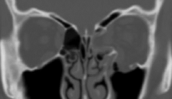 Orbital trauma and fractures