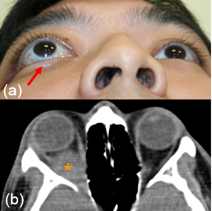 Protrusion of the right eye was due to a tumour behind the globe