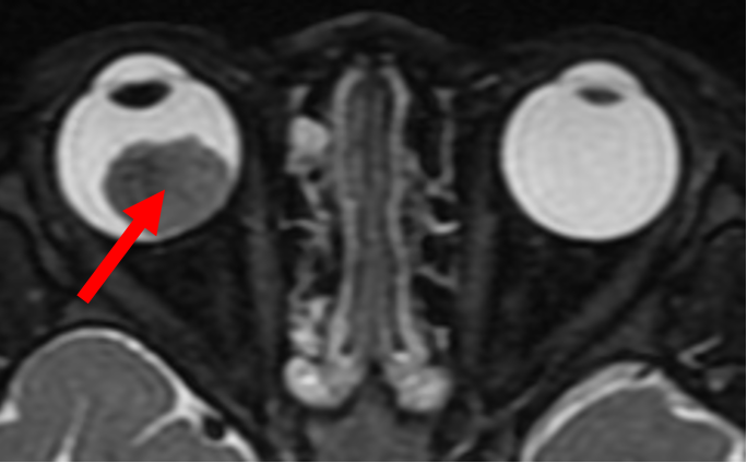 MRI-scan-of-retinoblastoma