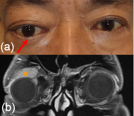 Inferior displacement of right globe, proptosis and fullness in right upper lid