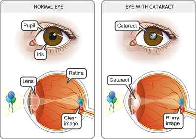 Normal Eye Vs Cataract