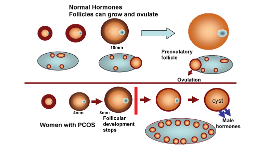 Cysts in PCOS