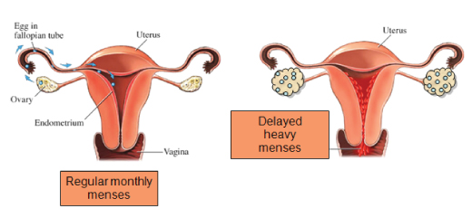 Regular monthly menses vs delayed heavy menses