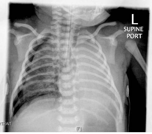 Respiratory Distress Syndrome