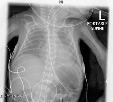 Respiratory Distress Syndrome