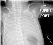 Respiratory Distress Syndrome