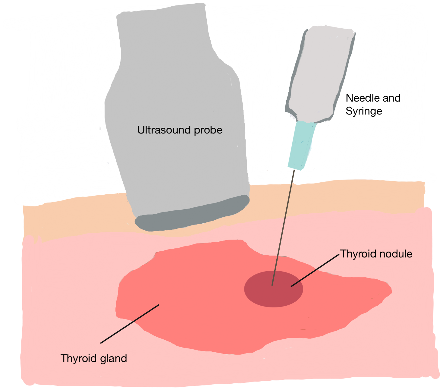 Ultrasound-guided fine needle biopsy of a thyroid nodule