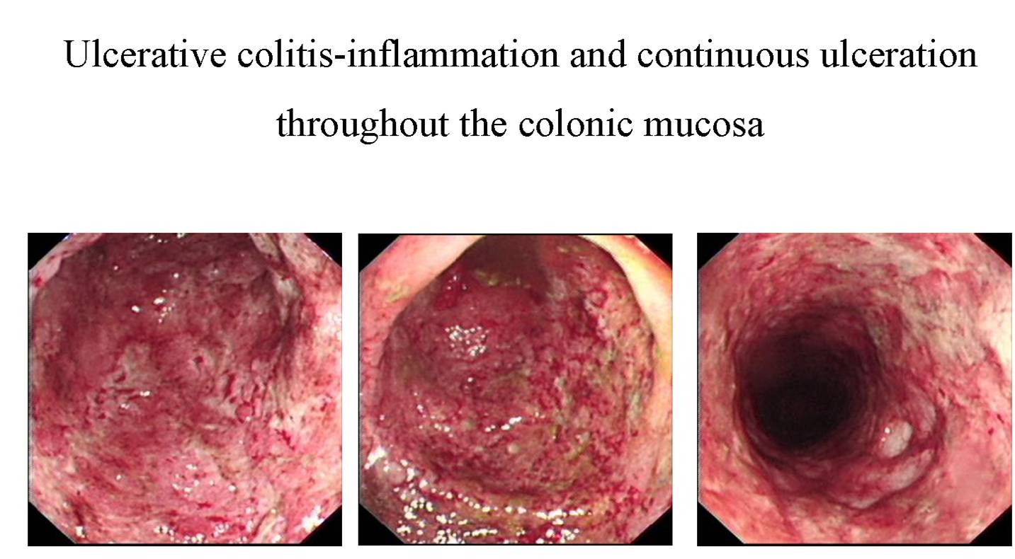 Ulcerative colitis-inflammation and continuous ulceration throughout the colonic mucosa